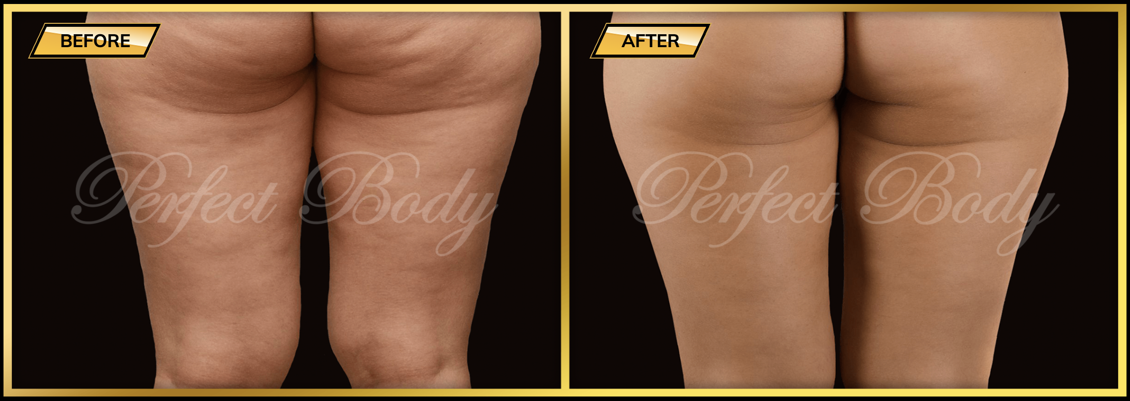 Advanced Cellulite Removal in Bay Shore NY for Smoother Skin Advanced Cellulite Removal in Bay Shore NY for Smoother Skin